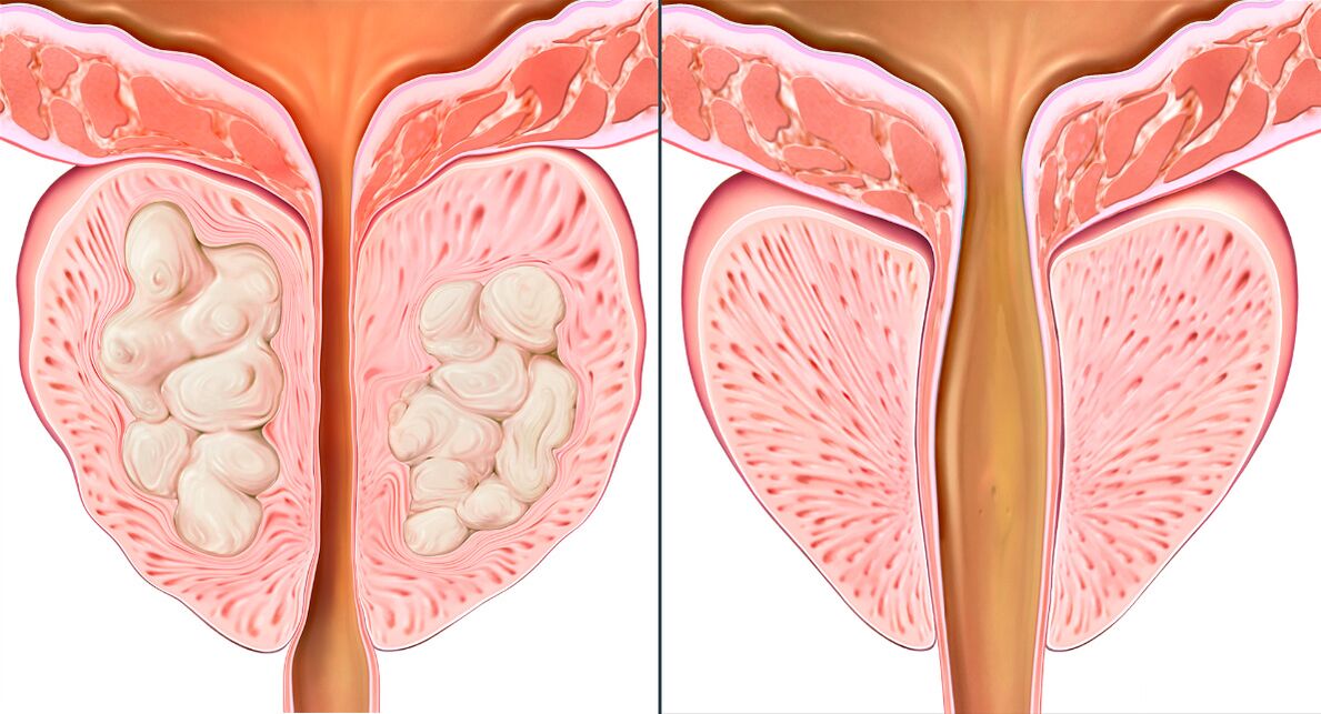 A prosztatagyulladás kezelésének szakaszai Prostalix-szal